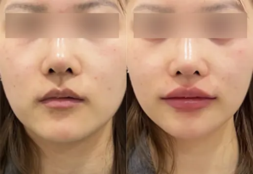 Before and after lip filler at PRIDQ Clinic, 1 week after treatment