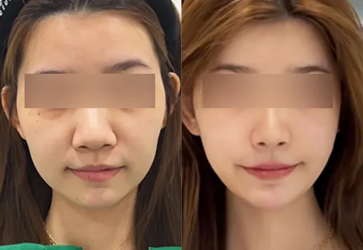 Before and after under-eye, nasolabial & side-cheek filler at PRIDQ Clinic, 2 weeks after treatment