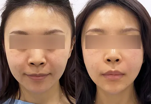 Before and after juvelook volume at PRIDQ Clinic, 3 weeks after treatment