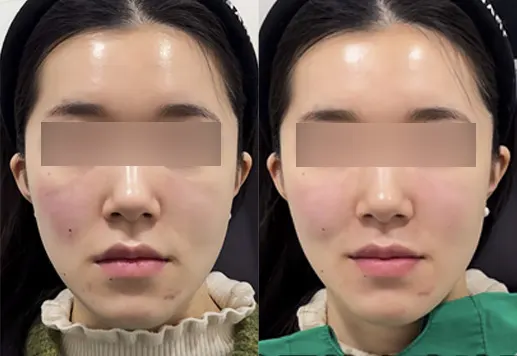 Before and after under-eye, indian band & nasolabial filler at PRIDQ Clinic, 2 weeks after treatment