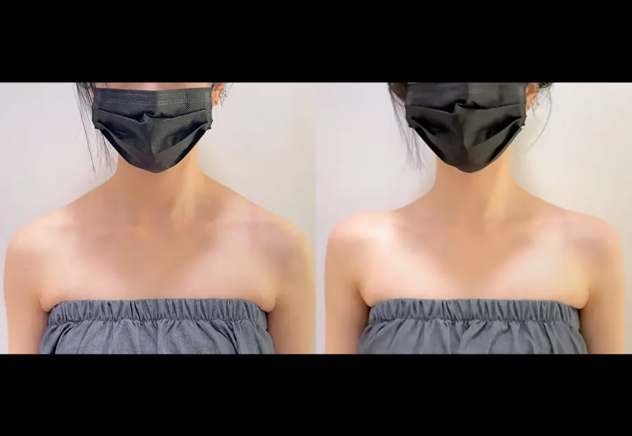 Before and after trapezius botox & shoulder filler at PRIDQ Clinic, 2 weeks after treatment