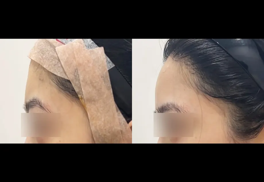 Before and after forehead filler at PRIDQ Clinic, 2 weeks after treatment