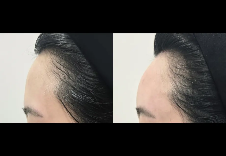 Before and after forehead filler at PRIDQ Clinic, 2 weeks after treatment