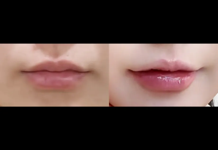 Before and after lip filler at PRIDQ Clinic, 1 week after treatment