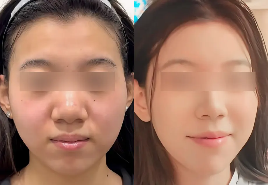Before and after alar botox, nose fat-dissolving injection, md codes and multi-area filler at PRIDQ Clinic, 1 month after treatment