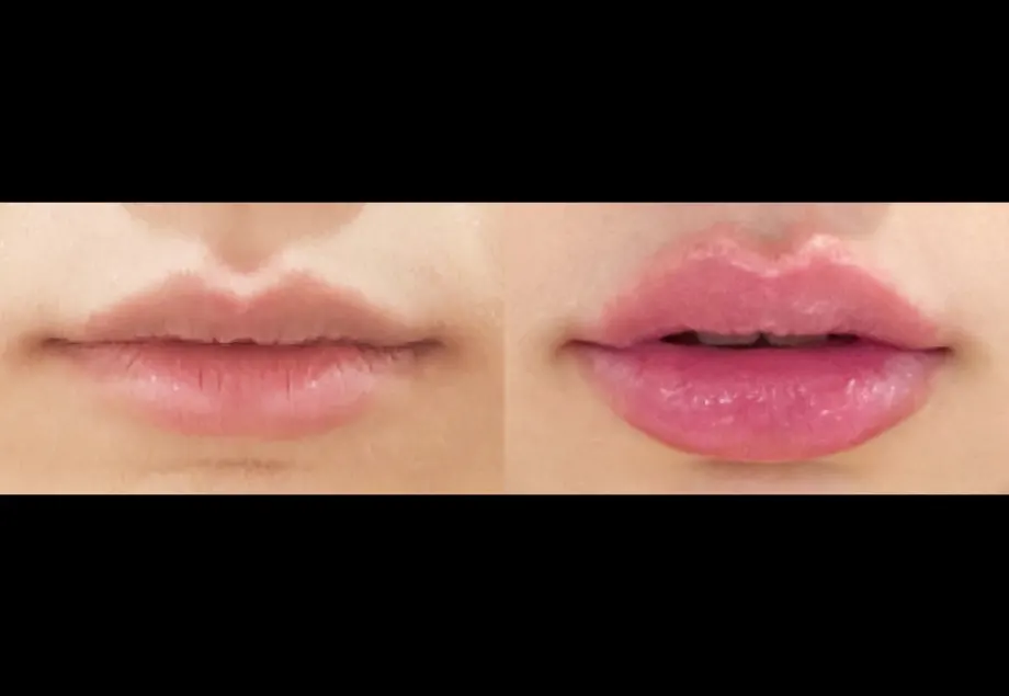 Before and after lip filler at PRIDQ Clinic, 2 weeks after treatment
