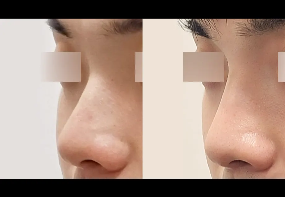 Before and after nose filler at PRIDQ Clinic, 2 weeks after treatment