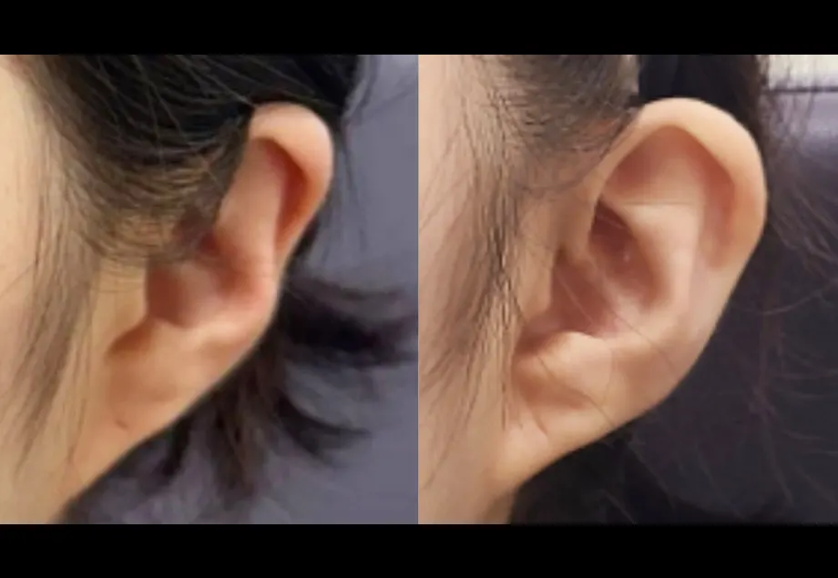 Before and after ear filler at PRIDQ Clinic, 2 weeks after treatment