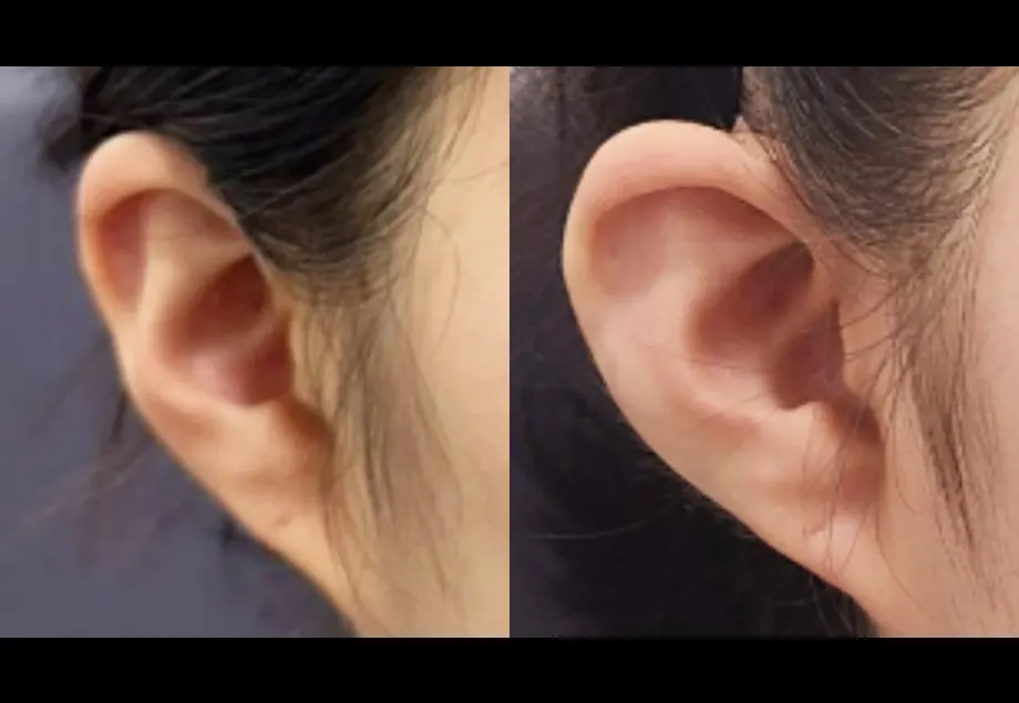 Before and after ear filler at PRIDQ Clinic, 2 weeks after treatment