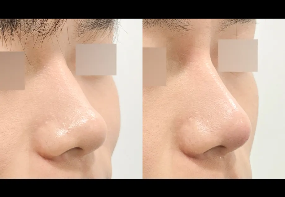 Before and after nose filler at PRIDQ Clinic, 2 weeks after treatment