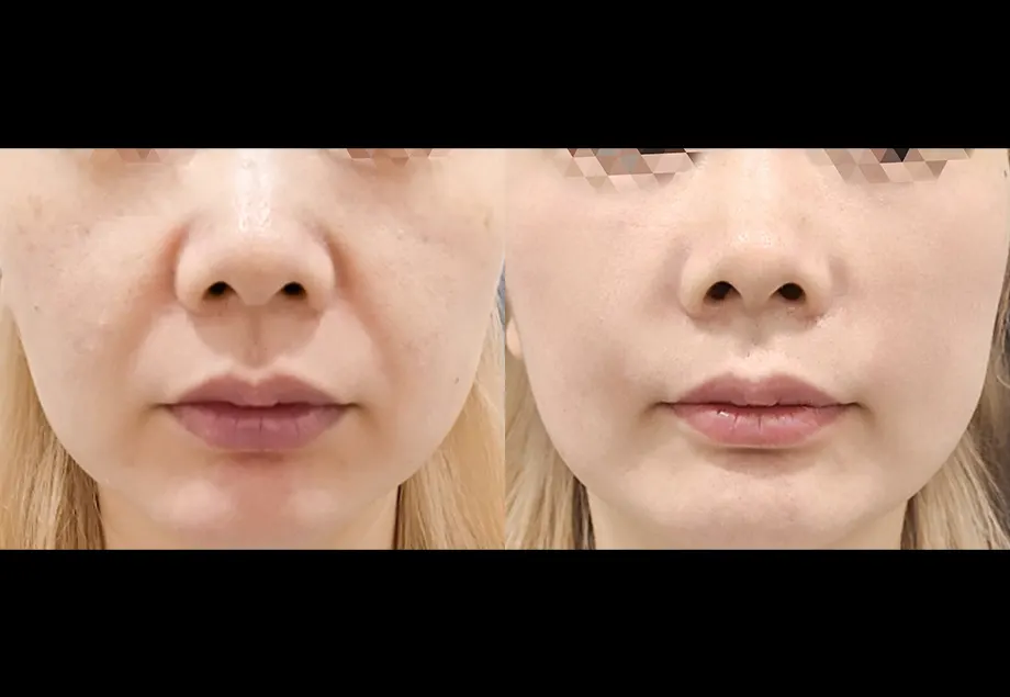 Before and after under-eye, indian line & nasolabial filler at PRIDQ Clinic, 2 weeks after treatment