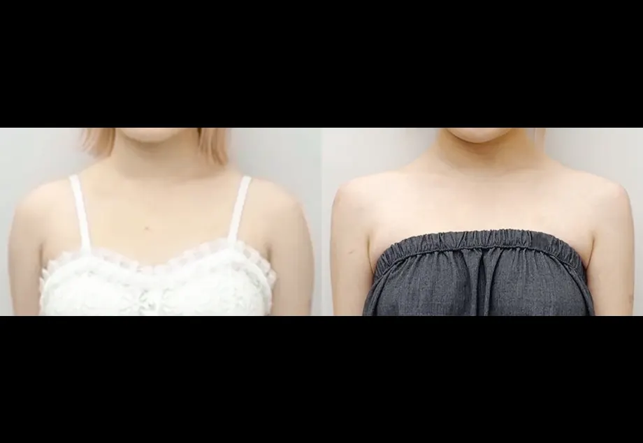 Before and after shoulder filler at PRIDQ Clinic, 2 weeks after treatment