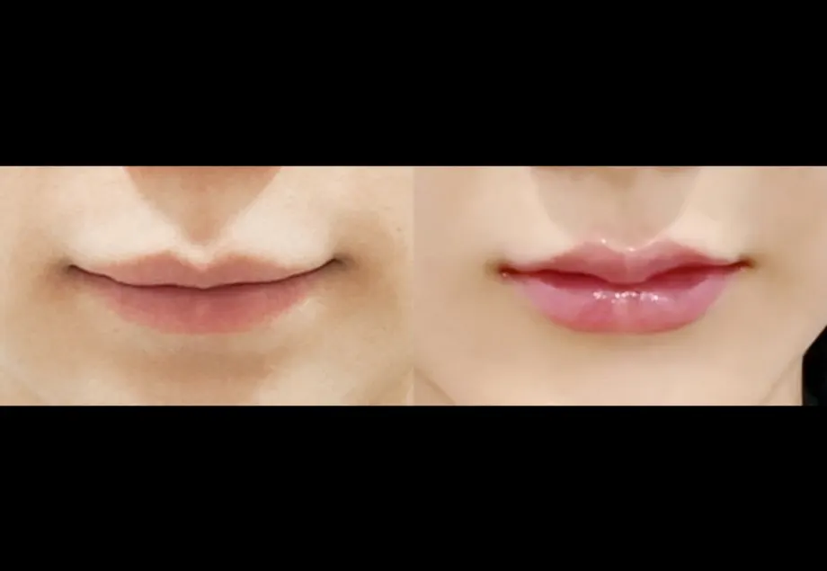 Before and after lip filler at PRIDQ Clinic, 2 weeks after treatment