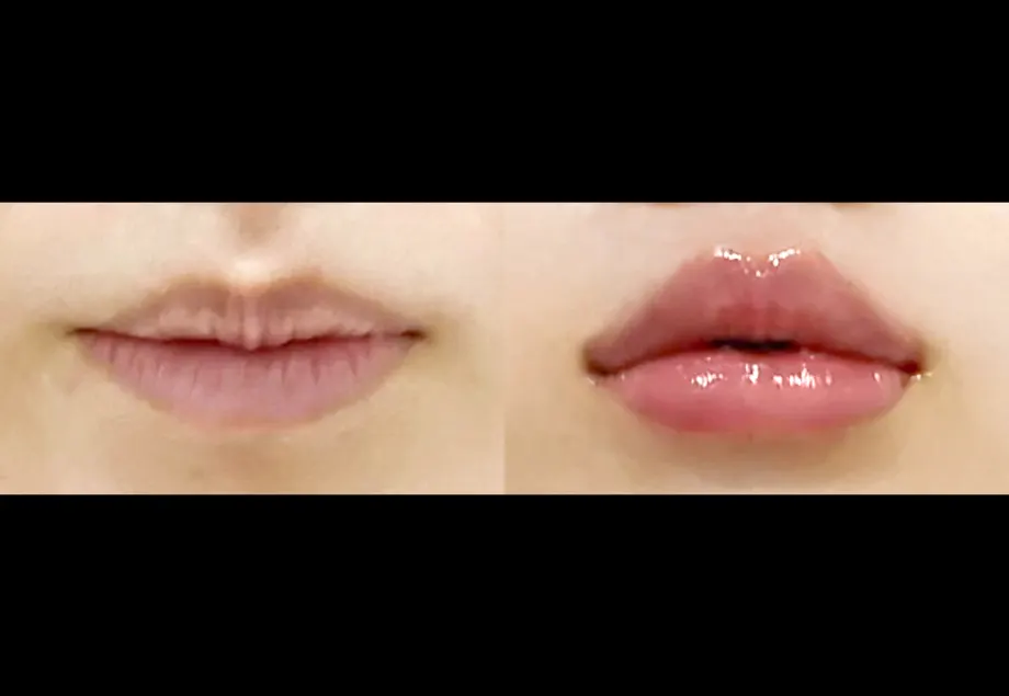 Before and after lip filler at PRIDQ Clinic, 2 weeks after treatment