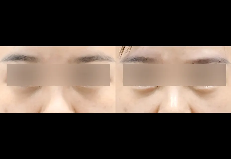 Before and after aegyo-sal (under-eye smile pouch) filler at PRIDQ Clinic, 2 weeks after treatment