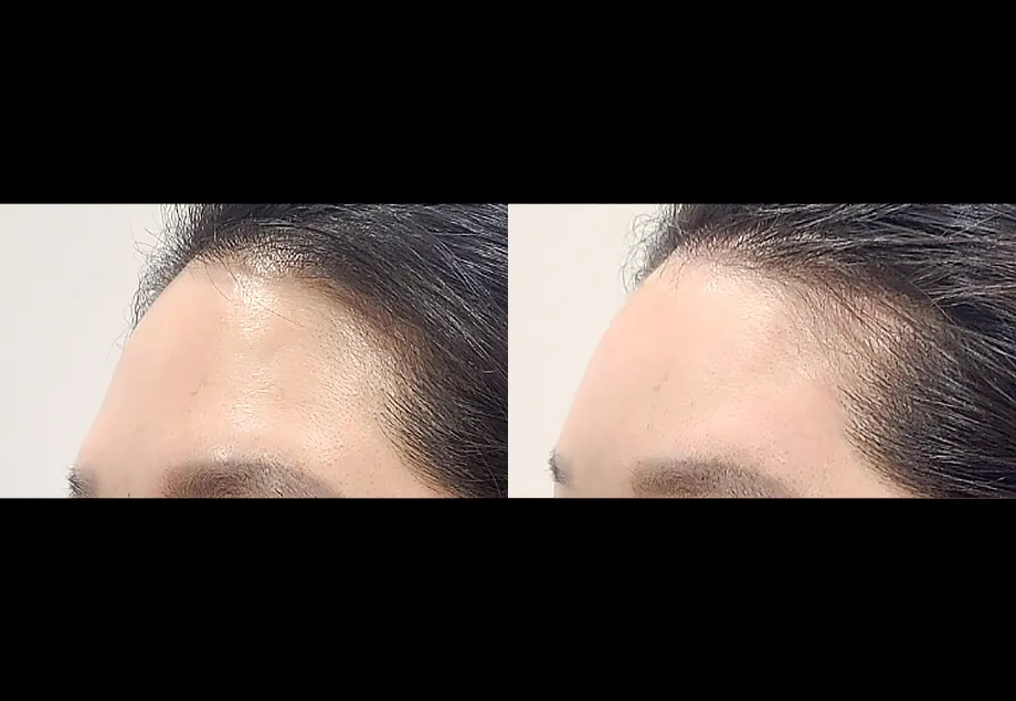 Before and after forehead filler at PRIDQ Clinic, 2 weeks after treatment