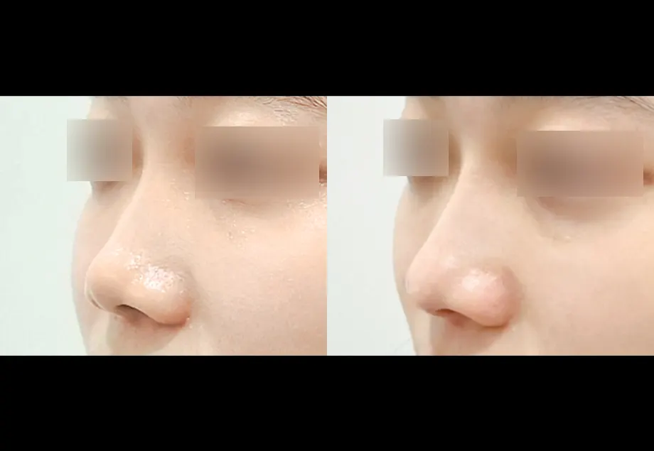 Before and after nose filler at PRIDQ Clinic, 2 weeks after treatment