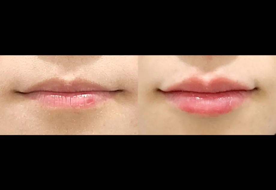 Before and after lip filler at PRIDQ Clinic, 2 weeks after treatment