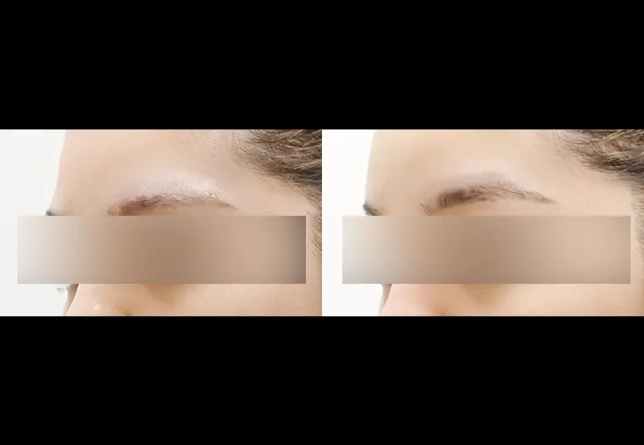 Before and after brow-bone filler at PRIDQ Clinic, 2 weeks after treatment